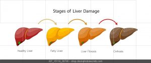 What is Fatty Liver? - Edmonds Medical Clinic