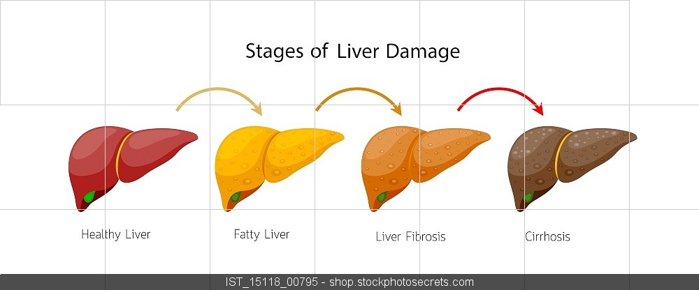 Fatty Liver Picture