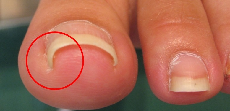 Ingrown toenail Pic 1